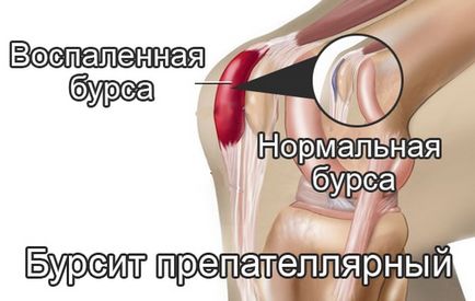 Bursita articulației genunchiului, simptome și modalități de tratare a acesteia