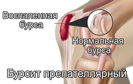 Бурсит колінного суглоба, симптоми і способи його лікування