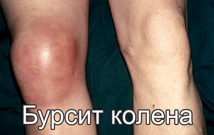 Бурсит колінного суглоба, симптоми і способи його лікування
