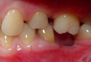 A veszély a hiányzó fogak és fogsorok miért szükséges intézkedés hiányában ezek nagyon