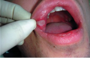 Ceea ce este periculos este absența dinților și de ce protezele sunt o măsură necesară în absența lor, foarte