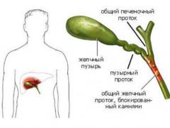 Чим небезпечне запалення протоки жовчного міхура