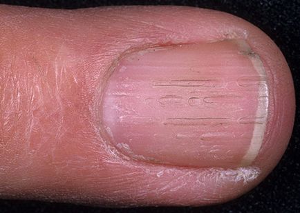 Ce trebuie să faceți în cazul în care unghiile sunt crăpate pe mâinile problemei umflăturilor unghiilor