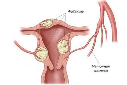 Що потрібно знати про маткових фіброма, жіночий журнал