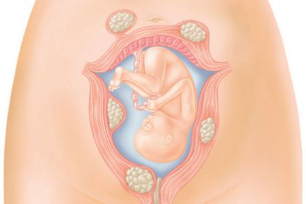 Що потрібно знати про маткових фіброма, жіночий журнал