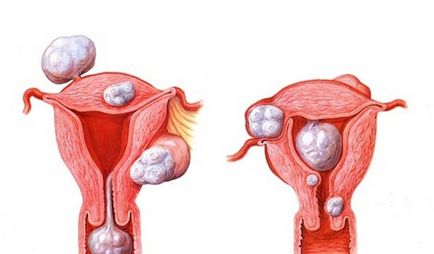 Ce trebuie să știți despre fibromul uterin, o revistă pentru femei