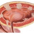 Ceea ce cauzează diverticulul vezicii urinare, simptomele, tratamentul, chirurgia