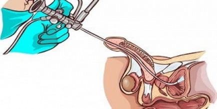 Ceea ce cauzează diverticulul vezicii urinare, simptomele, tratamentul, chirurgia