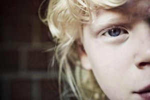 Albinismul copiilor