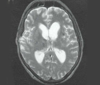 Defecte axonale ale creierului difuza - cauze, simptome, diagnostic și tratament