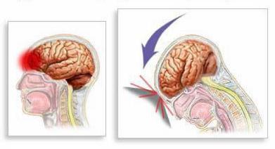 Diffúz axon degenerációt tünetek, jelek és diagnózis