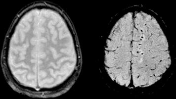 Difuze axonale simptome leziuni ale creierului, semne și diagnostic