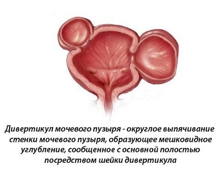 Diverticulul vezicii urinare - ceea ce este, cauzele apariției, tratamentului