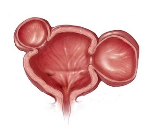 Húgyhólyag diverticulum diagnózis, a tünetek okait