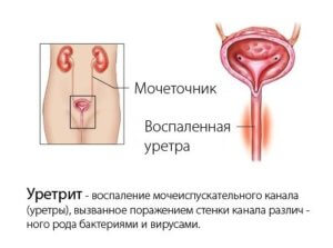 Diverticulul tratamentului vezicii urinare, cauze, simptome