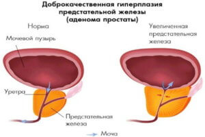 Diverticulul tratamentului vezicii urinare, cauze, simptome