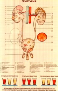 Diverticulul tratamentului vezicii urinare, cauze, simptome