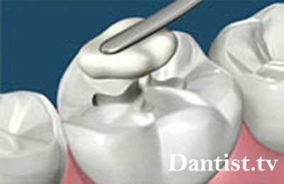 Endodontic stomatologie, ce este?