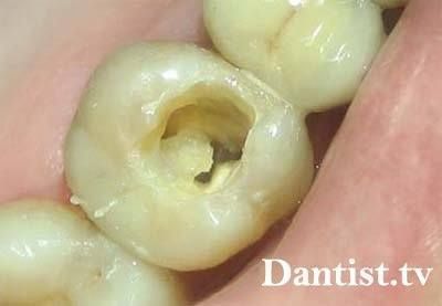 Endodontic stomatologie, ce este?