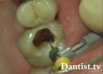 Endodontic stomatologie, ce este?