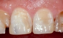 Eroziunea etiologiei smalțului dintelui, simptome, clasificare