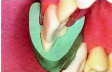 Etapele de pregătire a incisivului central al maxilarului superior sub coroana cermetă