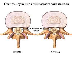 Stresul fizic la osteocondroza regretă - sau - injecta - teste înapoi