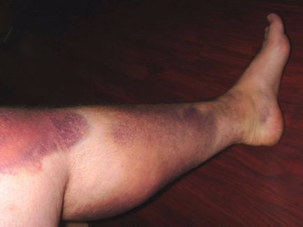 Vérömleny a lábán sérülés után, a kezelés, az oktatás fotók