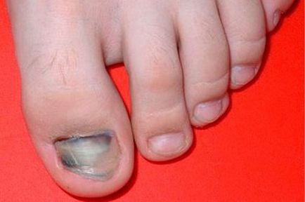 Гематома на нозі після удару, лікування, фото освіти