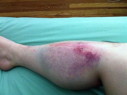Vérömleny a lábán sérülés után, a kezelés, az oktatás fotók