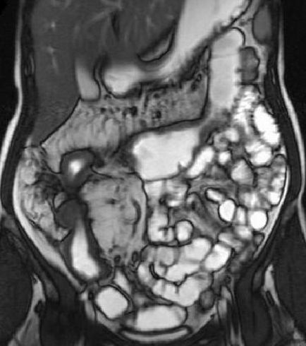 Hydro bél MRI Szentpéterváron