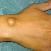 Hygroma din încheietura mâinii cauzează apariția și diverse tratamente, fotografii și recenzii