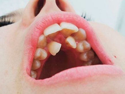 Hyperdontia (poliiodontia) la om ceea ce este dintii superficiali