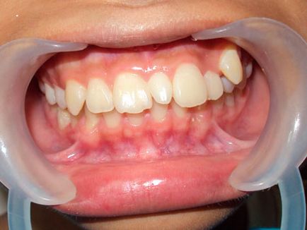 Hyperdontia (poliiodontia) la om ceea ce este dintii superficiali