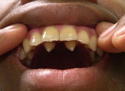 Hyperdontia (poliiodontia) la om ceea ce este dintii superficiali