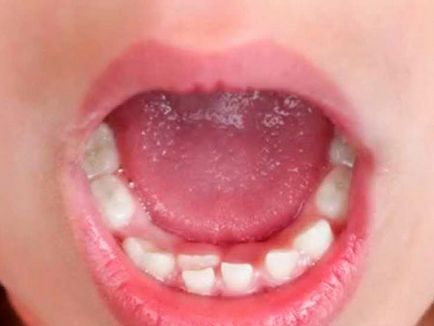 Hyperdontia (poliiodontia) la om ceea ce este dintii superficiali