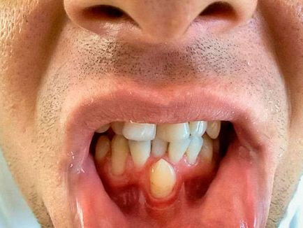 Hyperdontia (poliiodontia) la om ceea ce este dintii superficiali