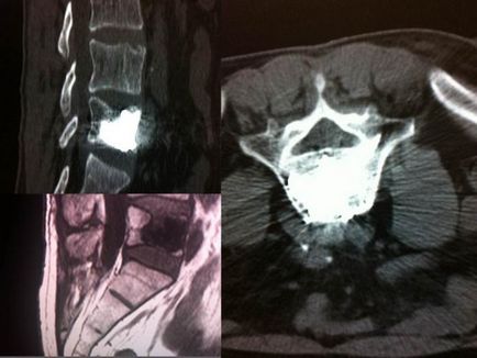 Tratamentul Hernia shmorlya