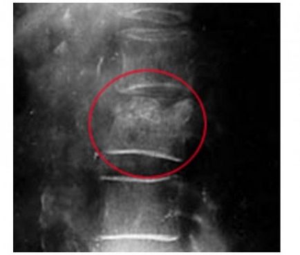 Hernia simptome hernie, diagnostic, tratament și prevenirea bolilor