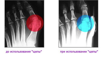 Hallufix ортопедични валгус шина-превръзка (hallyufiks) купите в Киев, цените в Украйна (Одеса,