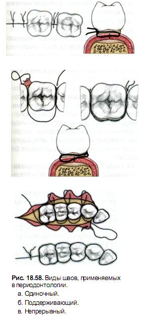 Használata varrat Parodontológia - parodontológia, periodontális sebészet - Sebészet