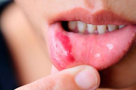 Meddig kezeljük stomatitis gyermekek időben és befolyásoló tényezők (stomatitis) Meddig kezeljük stomatitis gyermekek időben és befolyásoló tényezők