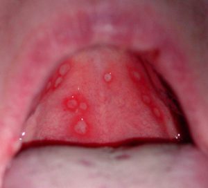 Meddig kezeljük stomatitis gyermekek időben és befolyásoló tényezők (gyermek) Meddig kezeljük stomatitis gyermekek időben és befolyásoló tényezők