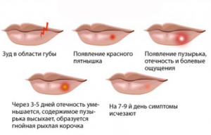 Як використовувати цинкову мазь при герпесі на губах