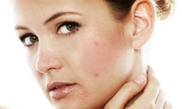 Cum pot elimina gropile după acnee și pot să o fac singură