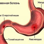 Каллезная виразка симптоми, причини і дієта - як лікування захворювання