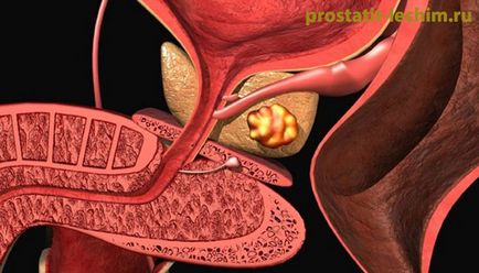 Pietre în prostată - Simptome și tratament