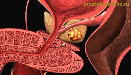 Камені в простаті - симптоми і лікування