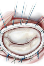 Cardiochirurgia defectelor valvei mitrale a inimii, spitalul orașului nr. 40