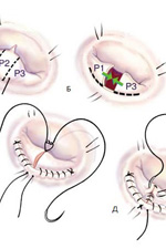 Cardiochirurgia defectelor valvei mitrale a inimii, spitalul orașului nr. 40